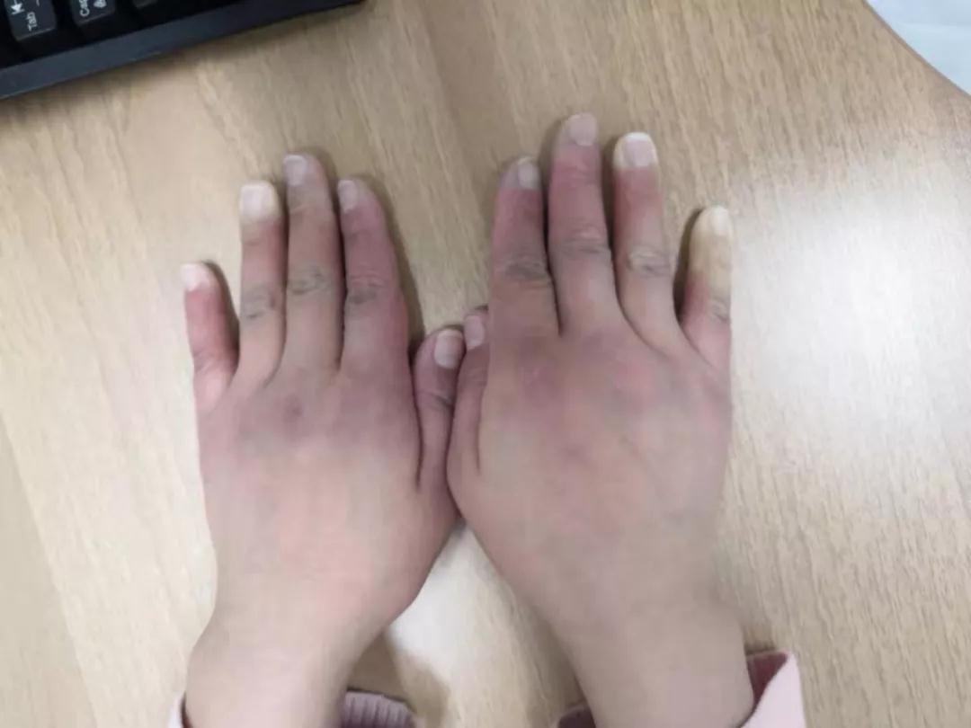 “手指、腳趾發(fā)白、發(fā)紫……”這些“小毛病”千萬別大意