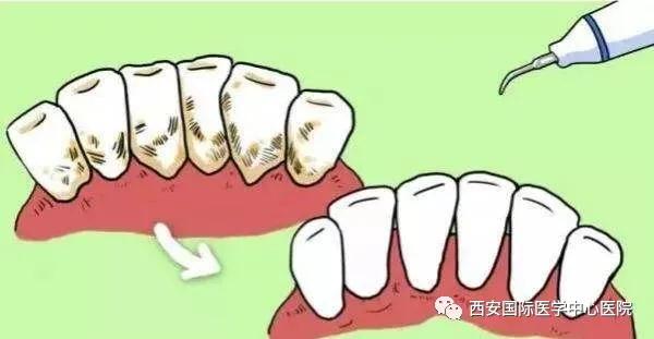 牙齒上的黃斑好難看，三招告訴你如何預(yù)防氟斑牙