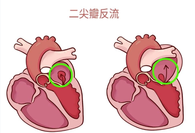 體檢報(bào)告里的心臟瓣膜返流，你讀懂了嗎？